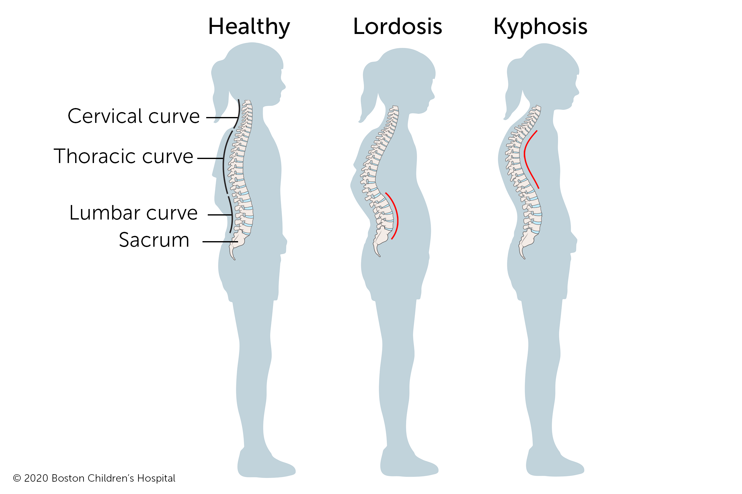 With kyphosis, the spine curves too far back, creating a hunchback appearance. With Lordosis, the spine curves too far forward. 