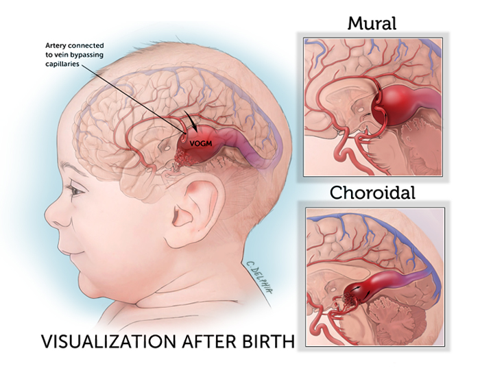 Vein of Galen Malformation (VOGM) After Birth