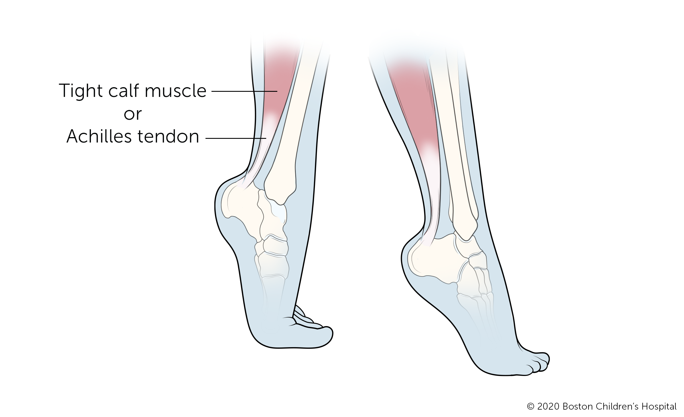 Here is what toe walking looks like.