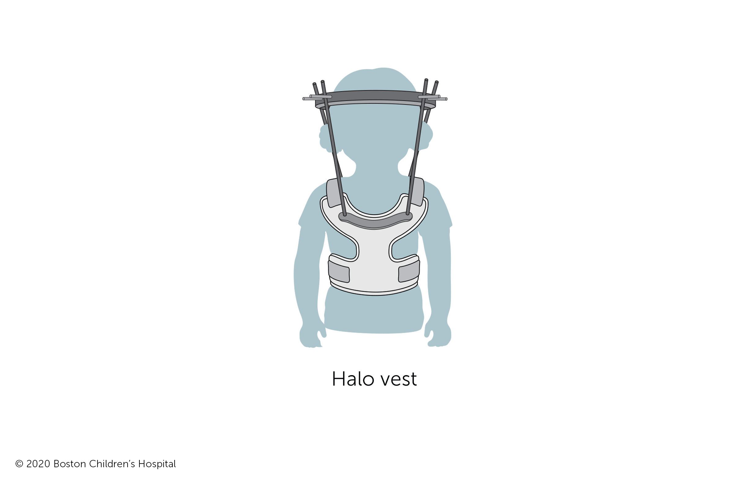 After halo traction, some children spend time in a halo vest that holds the head in place while the neck fully heals.