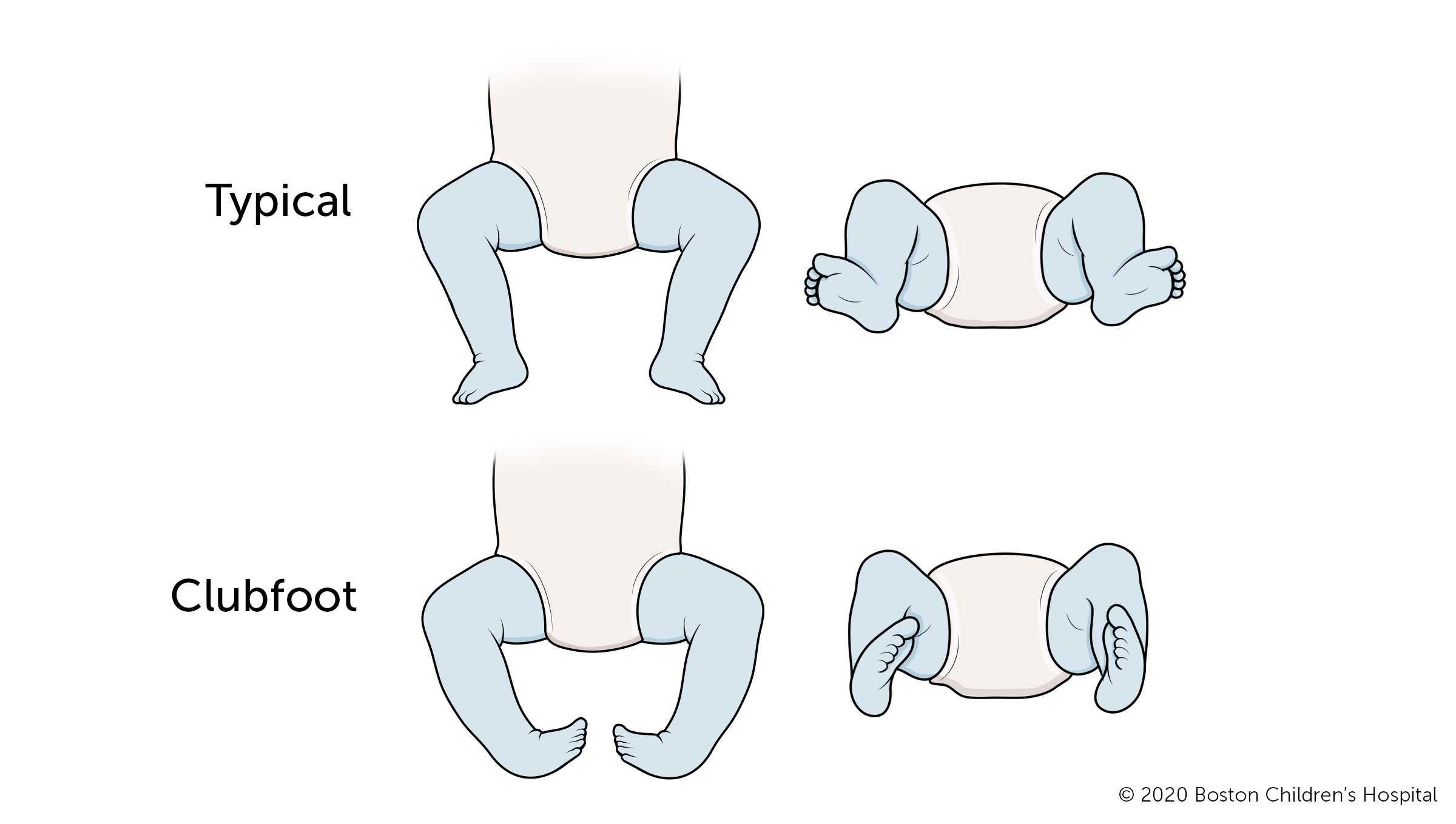 With clubfoot, the front half an affected foot turns inward and the heel points down.