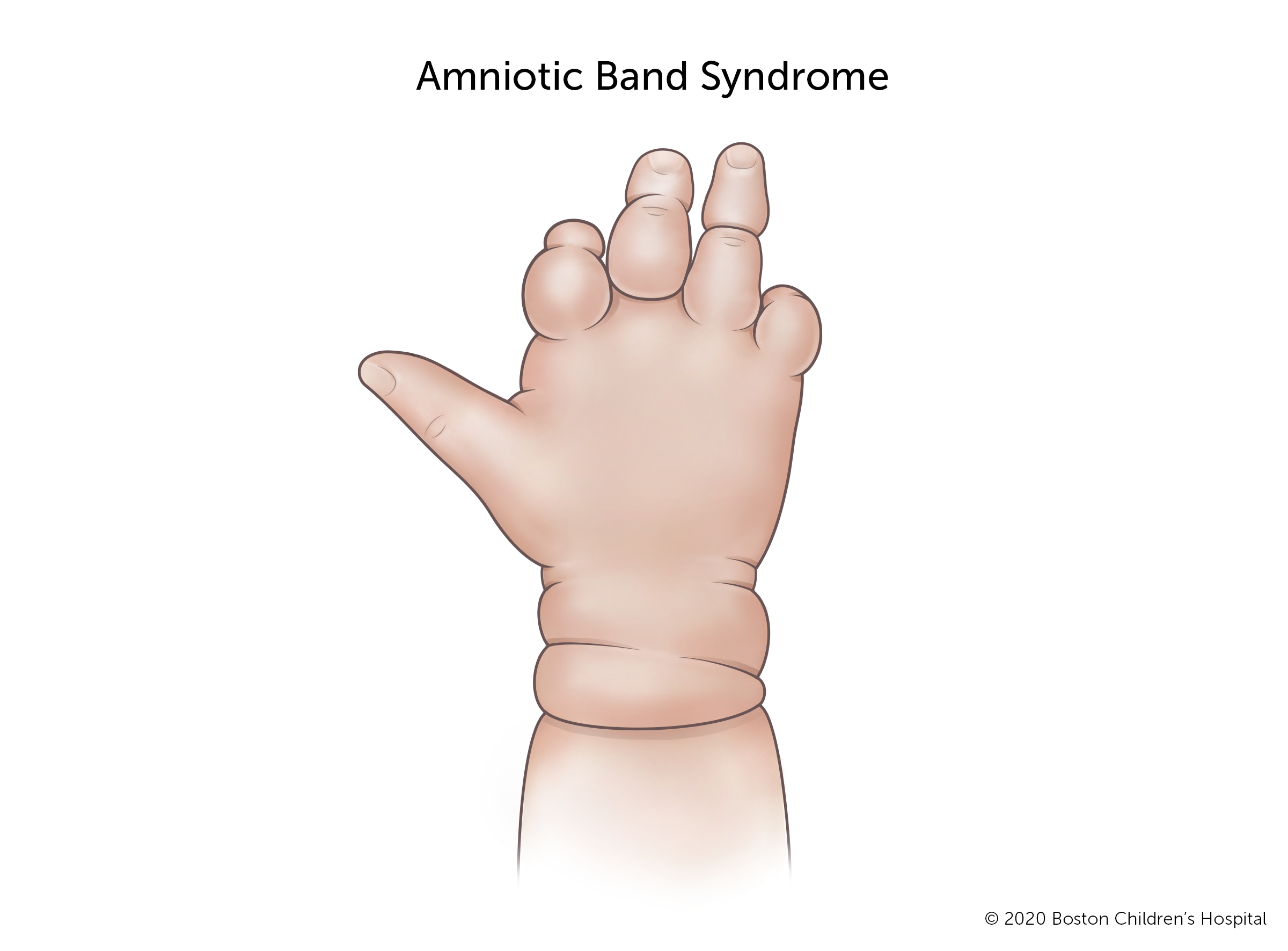 A hand with amniotic band syndrome has indented bands that wrap around the wrist and several fingers. Some of the bands are shallow. Other bands are deep and have changed the shape of the finger.