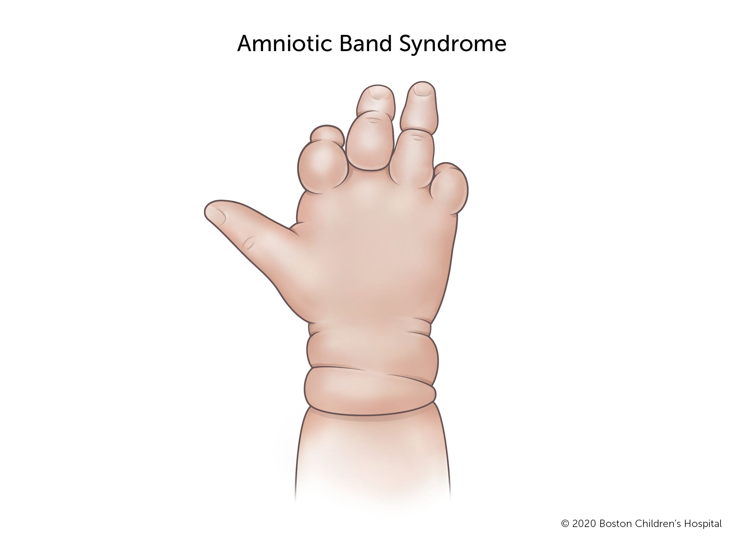 Is Amniotic Band Dangerous At Lachlan Legge Blog Is Amniotic Band Dangerous At Lachlan Legge Blog