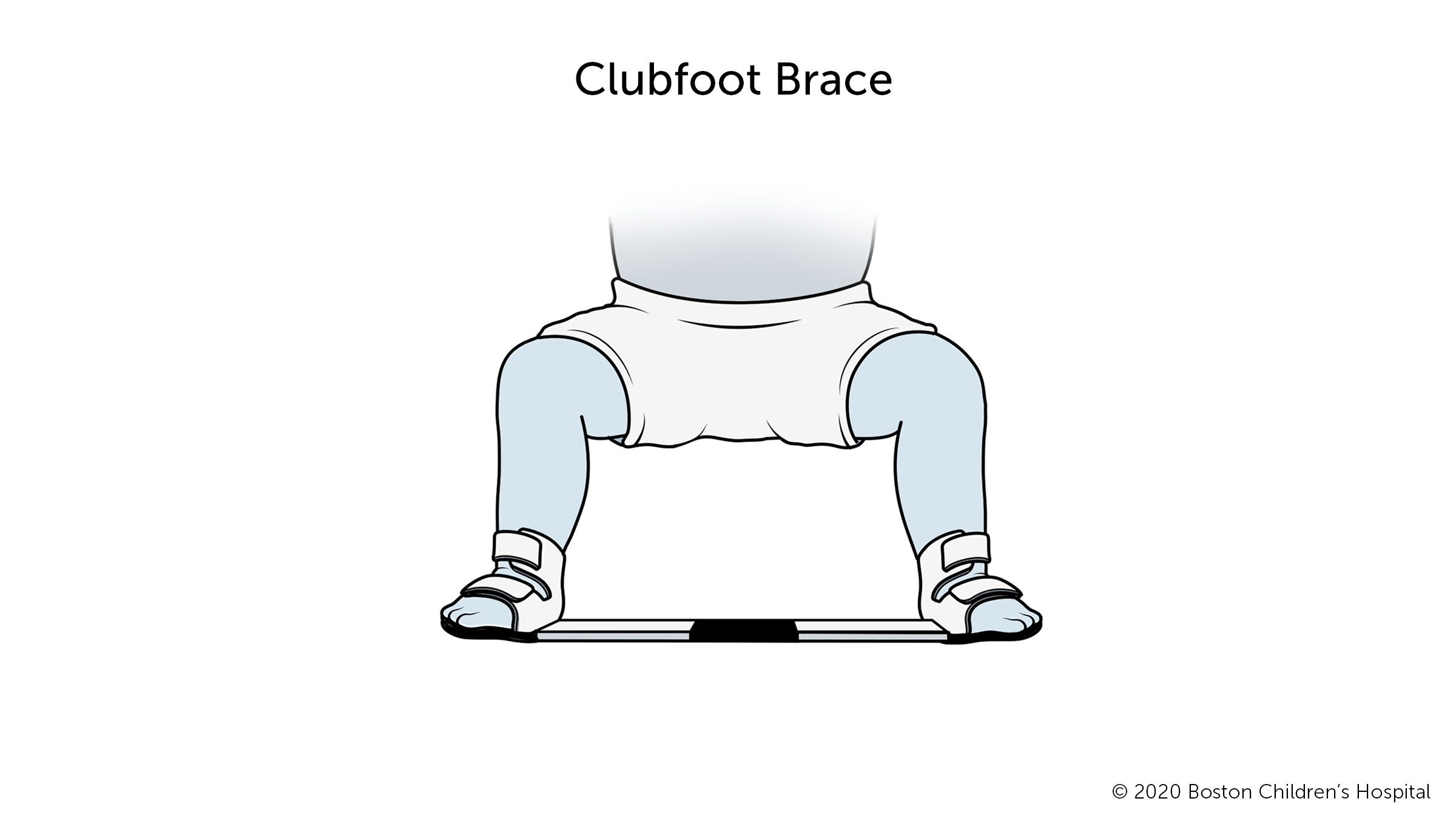 Clubfoot Boston Children S Hospital