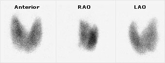 thyroid scan