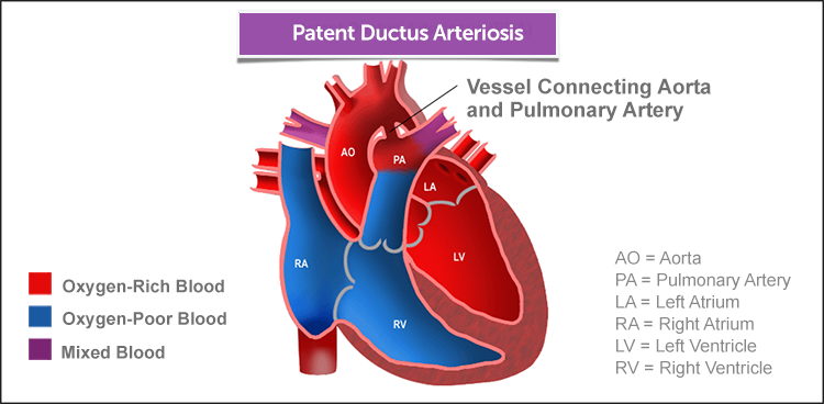 Patent Ductus Arteriosus | Boston Children's Hospital