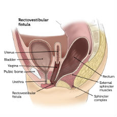 Rectovestibular Fistula