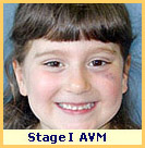 AVMs often appear as a stain on the child's skin at birth which enlarges in childhood and adolescence.