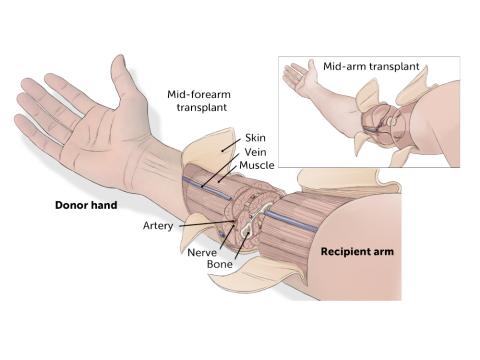 Key elements of a hand transplant