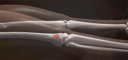 medical illustration of thighbone