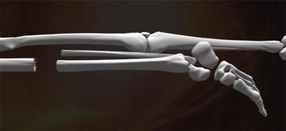 medical illustration of lower leg bone attached to femur bone