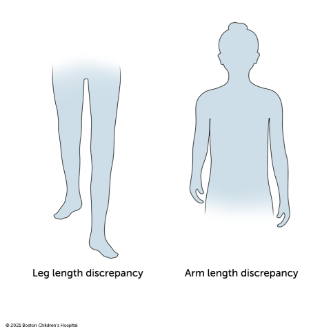 Leg length discrepancy and arm length discrepancy