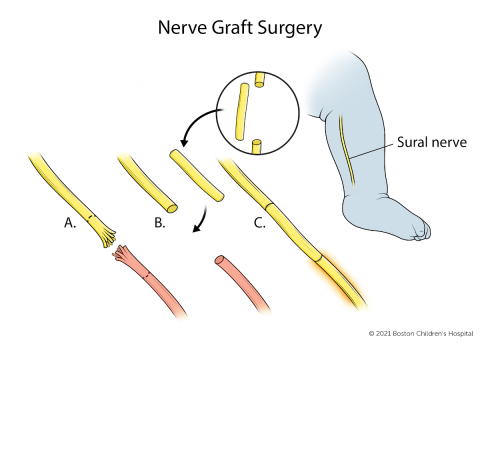 In nerve graft surgery, a healthy nerve is taken from another part of the body to replace the damaged section of nerve.