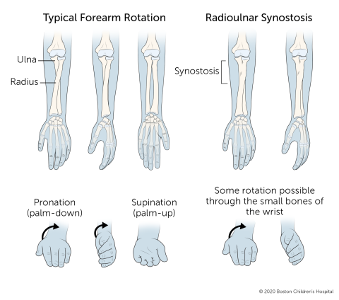 A typical forearm can rotate in both directions: the palm can face all the way down or all the way up. With radioulnar synostosis, the ulna and radius are connected, limiting rotation.