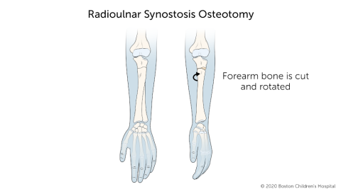 During osteotomy surgery for radioulnar synostosis, the two bones of the forearm are cut and rotated to improve use of the arm.