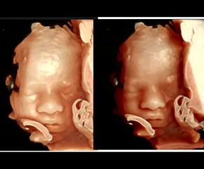 Ultrasound showing two images of face of baby in womb