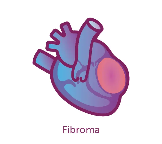 Image of a fibroma