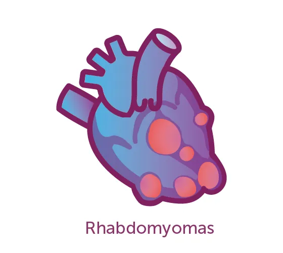Image of a rhabdomyoma