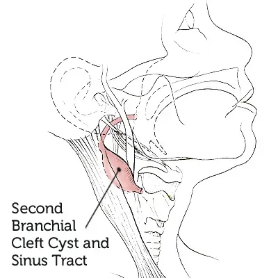 Second-Branchial-Cleft-Cyst-Sinus-Tract