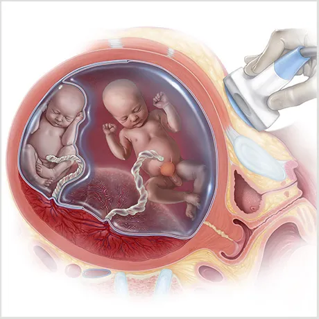 Illustration of two fetuses in a womb
