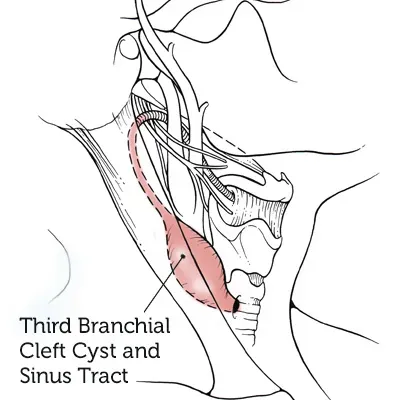 Third-Branchial-Cleft-Cyst-Sinus-Tract