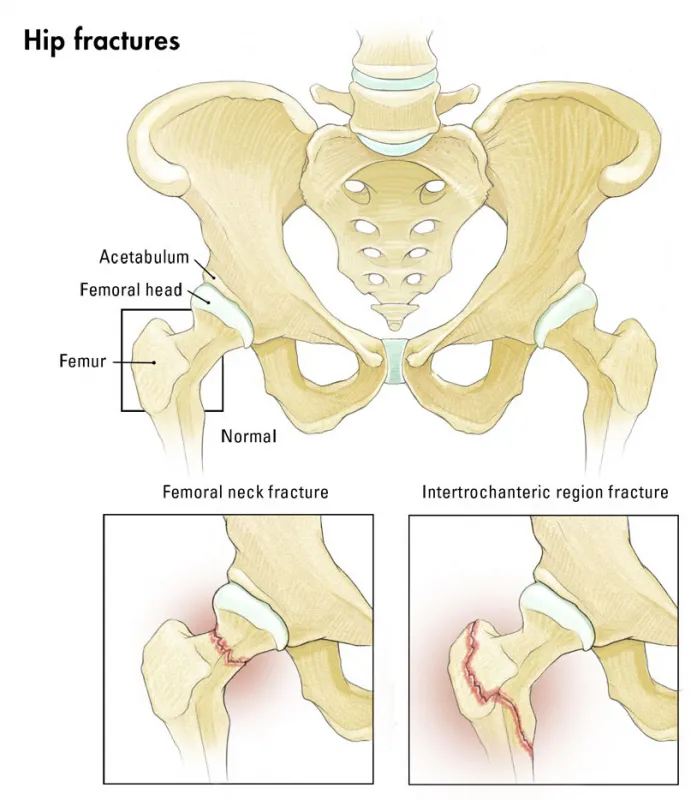 Medical diagram of pelvis showing hip anatomy and two fracture types: femoral neck fracture and intertrochanteric fracture.