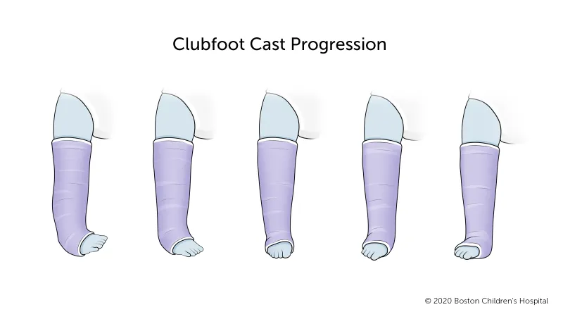 Illustration showing five stages of clubfoot cast progression, with each leg gradually straightening from left to right as the foot moves from an inward curve to a forward-facing position.