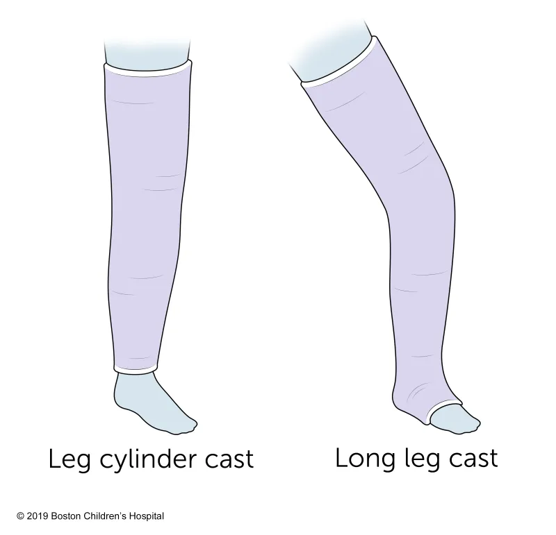 Illustration showing two types of leg casts: a leg cylinder cast covering the lower leg and knee, and a long leg cast covering the entire leg from foot to thigh.
