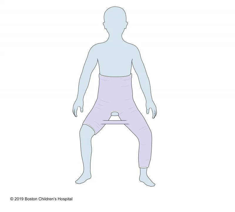 A medical illustration of a child wearing a spica cast that extends from the chest down to both ankles, with an opening at the pelvic area, leaving the feet and one knee exposed. © 2019 Boston Children’s Hospital.