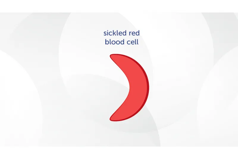 Diagram labeled "Sickled red blood cell" showing a curved, crescent-shaped red blood cell.