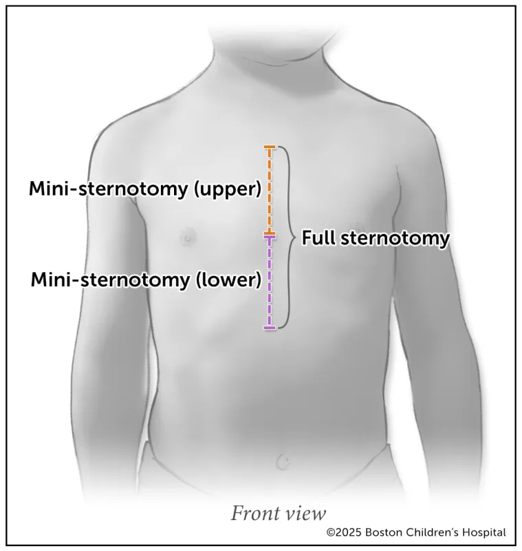 A medical illustration of the incision spots for three approaches to a sternotomy.