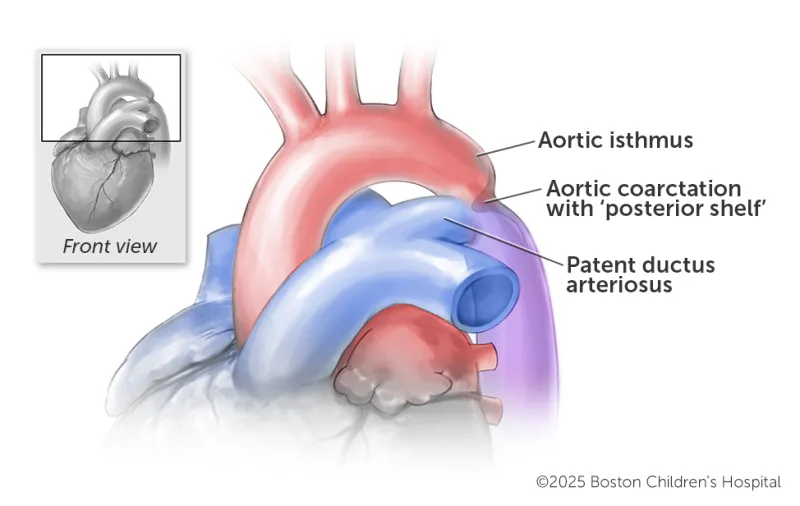 Medical illustration of a structurally normal heart with coarctation of the aorta