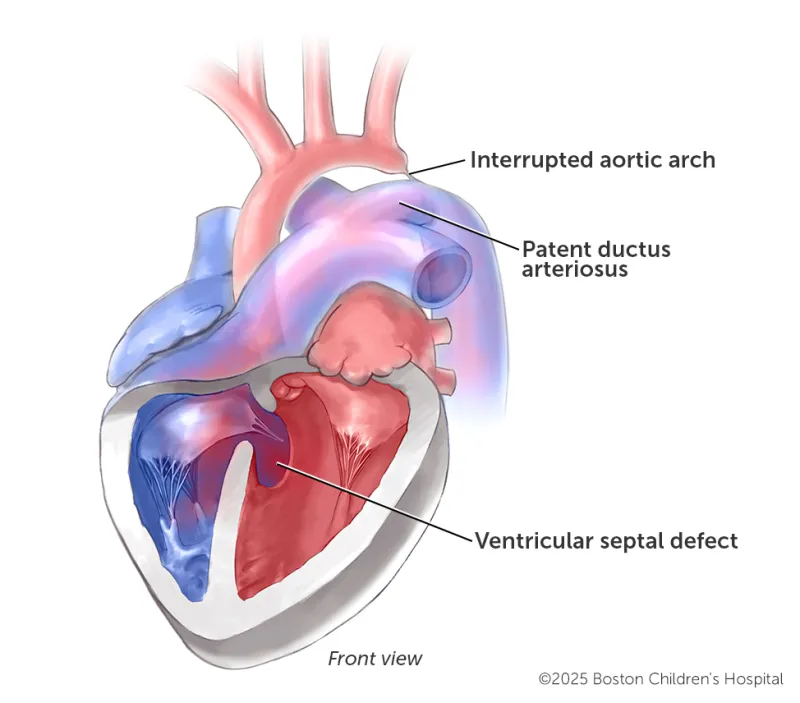 Medical illustration of a coarctation of the aorta with ventricular septal defect and interrupted aortic arch.