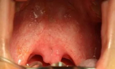 Image of submucous cleft palate