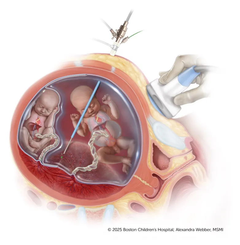 A medical illustration showing laser treatment for TTTS using a small camera and laser to block abnormal blood flow between twins in the placenta.