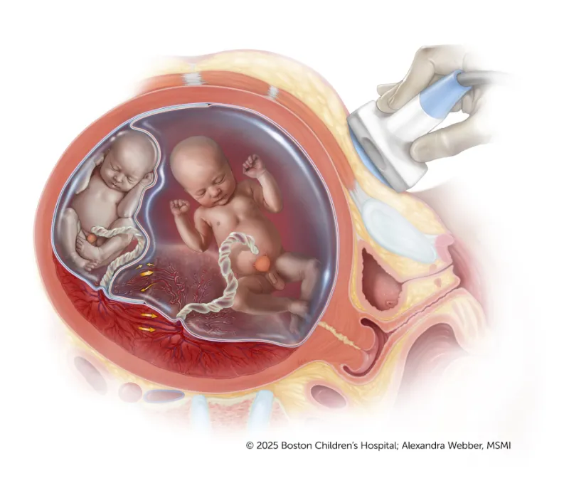 A medical illustration showing an ultrasound scan of a uterus with twins in separate amniotic sacs, sharing a placenta.