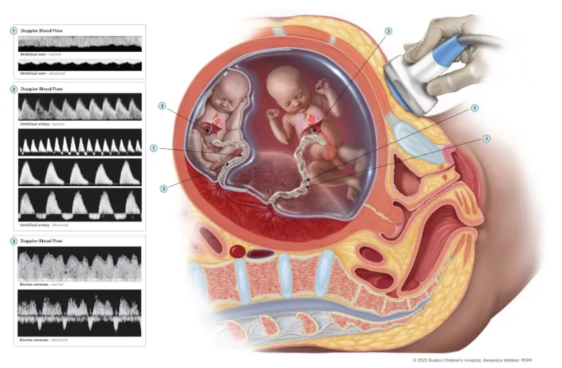 Medical illustration showing a uterus with twins, labeled umbilical cords, and Doppler ultrasound measuring blood flow patterns.