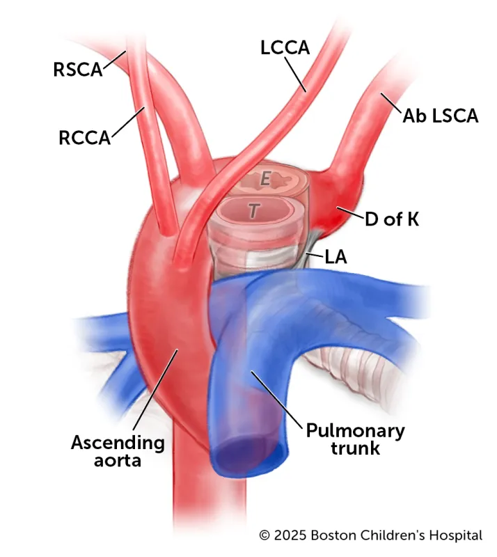 A medical illustration highlights key features of a right aortic arch with aberrant subclavian and left ligamentum.