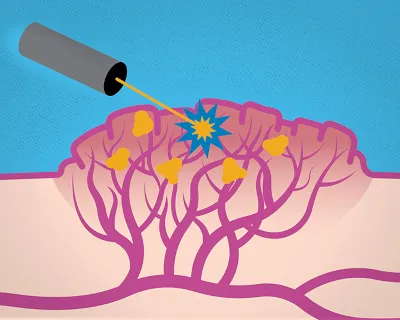 An illustration of nanoparticles in a venous malformation being hit with a beam of light.