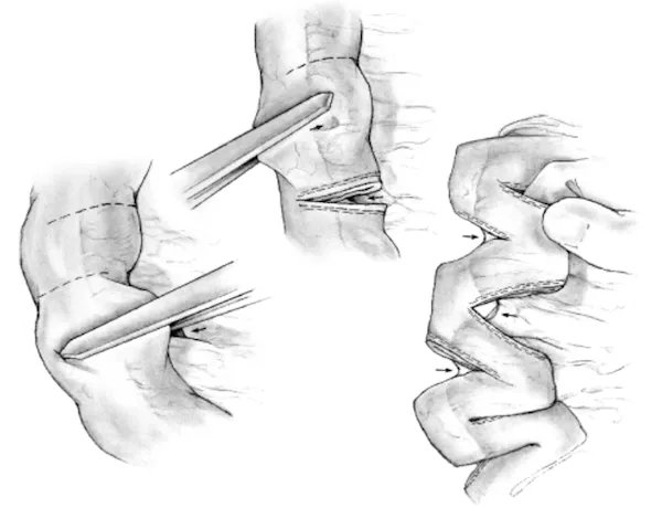 Serial Transverse EnteroPlasty 