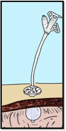 An image of MIC-G tube in stomach