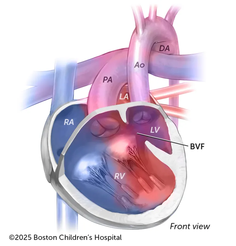 A medical illustration of double inlet left ventricle.