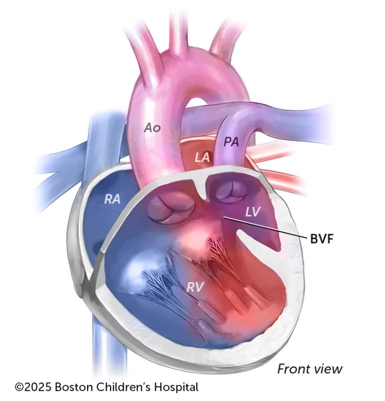 A medical illustration of double inlet left ventricle with transposition of the great arteries.