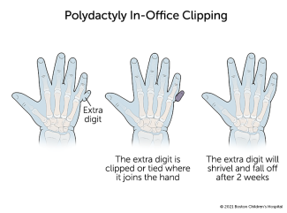 Polydactyly (Extra Fingers or Toes) and Corrective Surgery